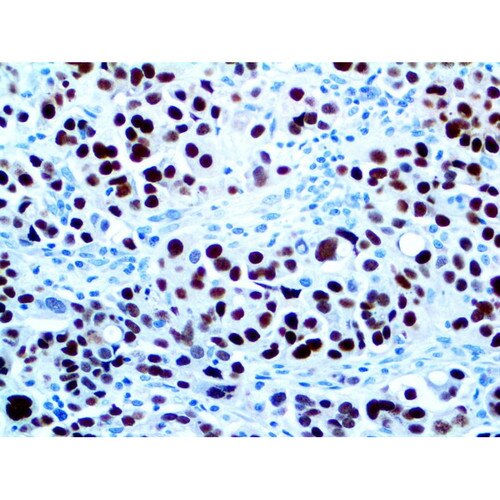 PAX-8 ZR-1 Antibody Immunohistochemistry on a FFPE Ovarian Carcinoma Tissue